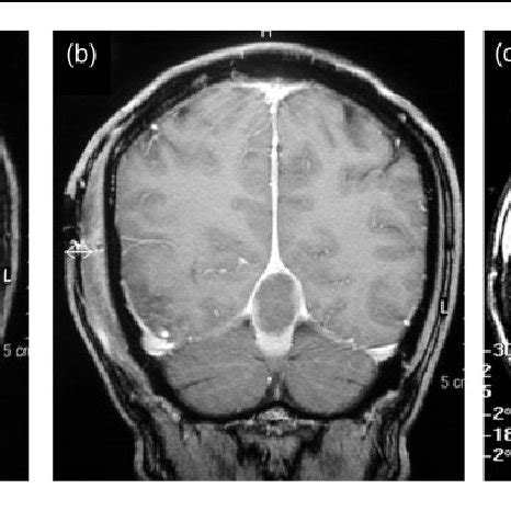 MRI demonstrating meningioma at the apex of the tentorial incisura: (a ...