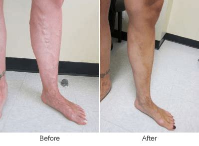 Varicose Vein Treatments & Sclerotherapy Treatment in St. Louis ...