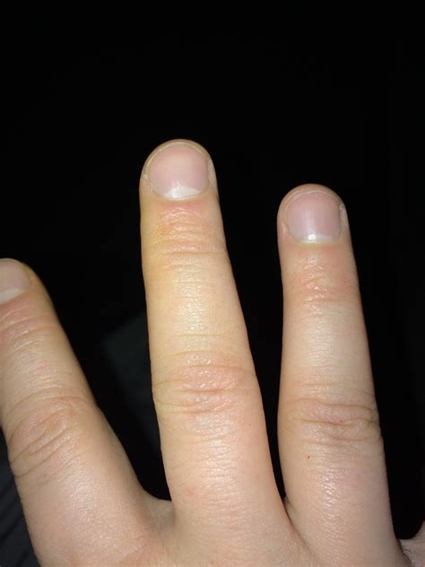 Пупырышки На Пальцах Рук Фото – Telegraph