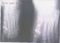 Full Text: Scarf osteotomy - Is it the procedure of choice in hallux valgus surgery? A ...