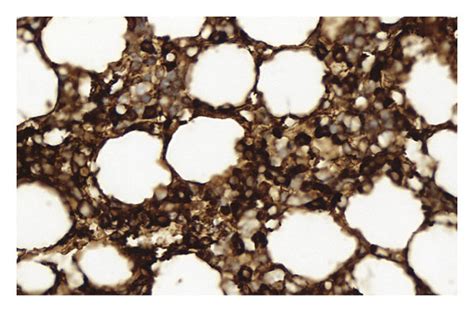 Case 2 The Patient With Final Diagnosis Of Multiple Myeloma A Download Scientific Diagram