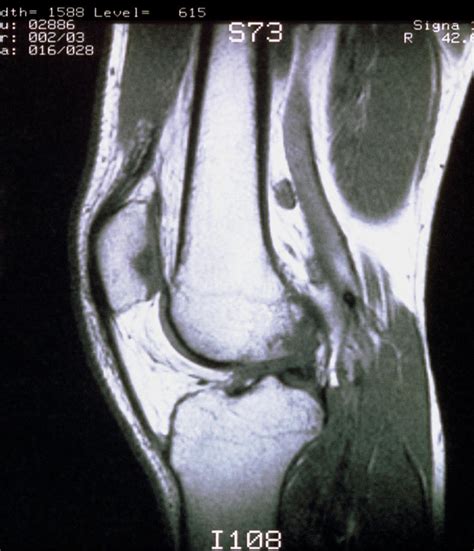 Mri Scan Of Sagittal Section Through Knee Joint Photograph By Science