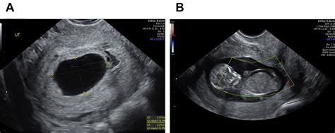 Ultrasound in Early Pregnancy - Obstetrics and Gynecology Clinics