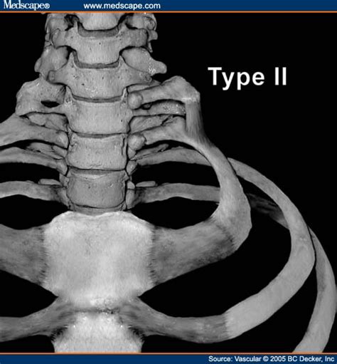 Endoscopic Transaxillary First Rib Resection For Thoracic Outlet