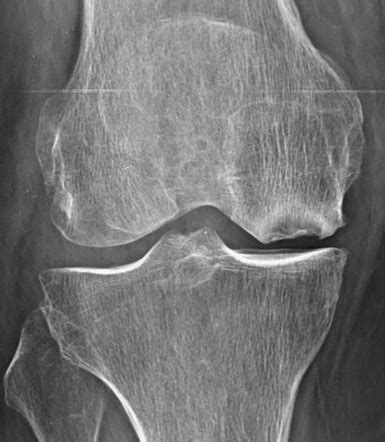 Osteochondritis dissecans of the knee | Radiology Case | Radiopaedia.org