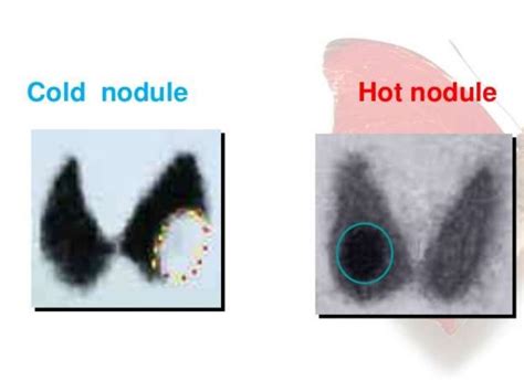 Nuclear Medicine Thyroid Procedurescan