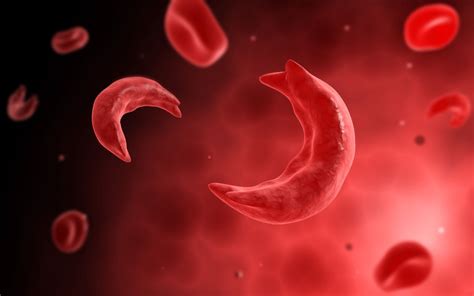 Sickle Cell Disease Symptoms Causes Diagnosis And Treatment