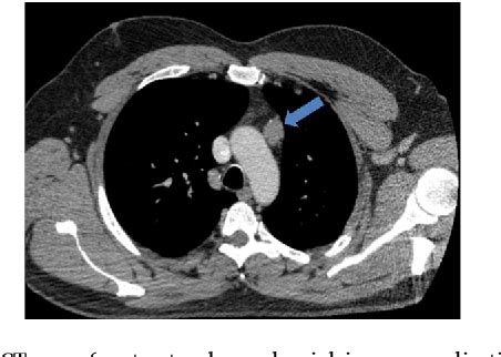 Rare Case Of Cavernous Hemangioma Of The Thymus Semantic Scholar