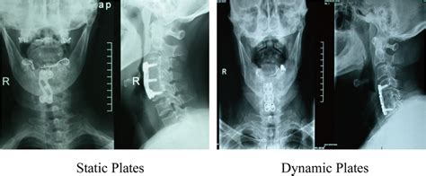 X Ray View Of Anterior Cervical Corpectomy And Fusion Post Operation Download Scientific