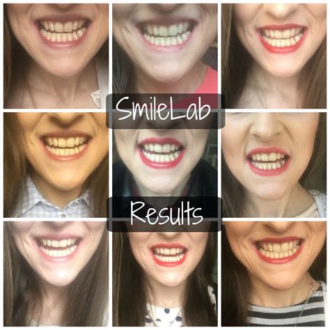 Smilelab Teeth Whitening Strips The Results