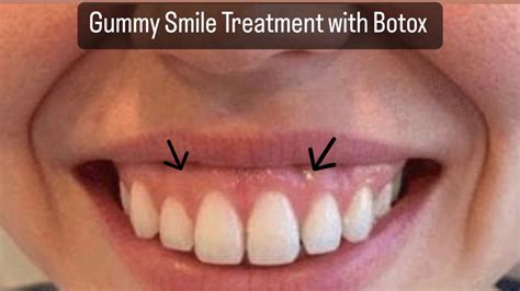 Gummy Smile Treatment Botox | General Medicine