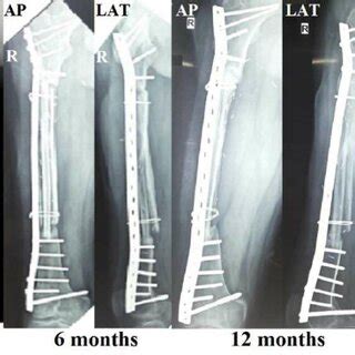 Immediate Post Op X Ray Right Femur Showing Good Graft Position And