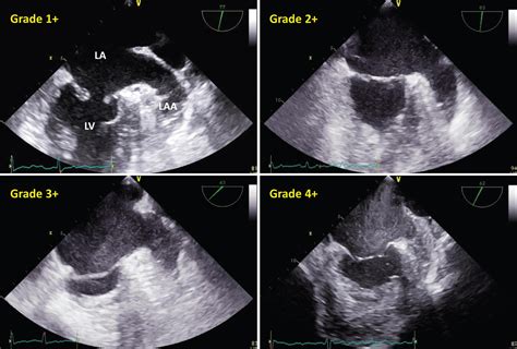 Left Atrial Spontaneous Echo Contrast Relationship With Clinical And Echocardiographic