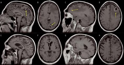 Mri Of A Patient With Multiple Brain Metastases Arrows Pre A D And