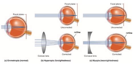 A Person Is Wearing Spectacles With Concave Lenses For Correcting