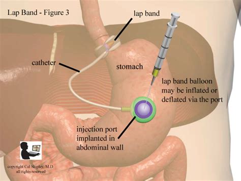 Lap Band Inflation Port Trial Image Inc