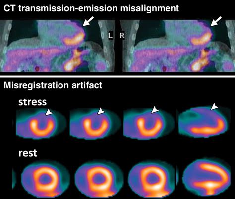 Cardiac PET CT For The Evaluation Of Known Or Suspected Coronary Artery