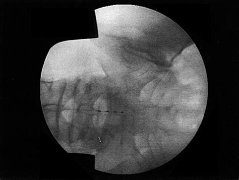 Percutaneous Cephalocaudal Implantation Of Epidural Stimulation Electrodes Over Sacral Nerve