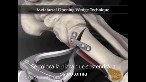 Osteotomia Proximal De Hallux Valgus YouTube