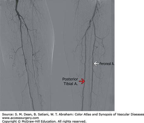 Femoral Popliteal Disease Bypass Thoracic Key