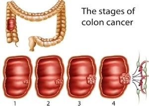 colon cancer stages | Anatomy System - Human Body Anatomy diagram and chart images