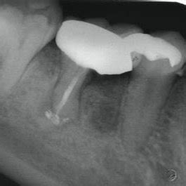 Hemisection procedure of tooth 46, (a) Flap incision, (b) crown ...