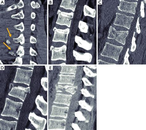 Type A Fractures Of The Aospine Tlics A A0 Fracture Affects Only The