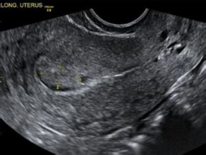 Endometrial polyp (Home) - Private Gynaecology