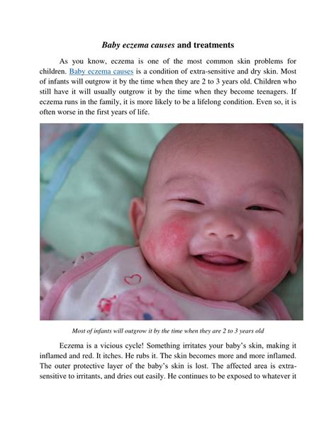 PPT - baby eczema causes PowerPoint Presentation, free download - ID ...