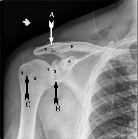 Shoulder X-ray Diagram | Quizlet