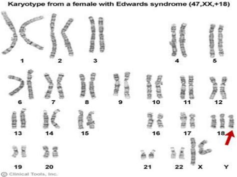 PPT - CHROMOSOMAL ABNORMALITIES PowerPoint Presentation - ID:5719987