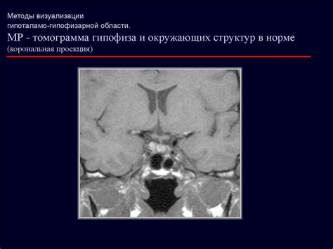 Заболевания гипоталамо-гипофизарной системы. Этиология, патогенез