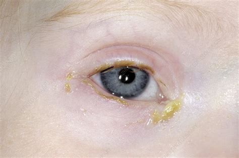 Acute Bacterial Conjunctivitis Stock Image C002 4926 Science