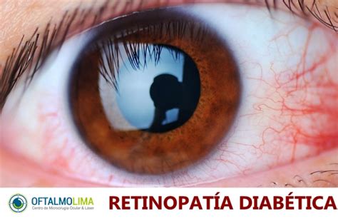 Retinopatía Diabética causas síntomas prevención y tratamientos