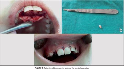 Figure 2 From Management Of Luxation Injury And Associated Impacted