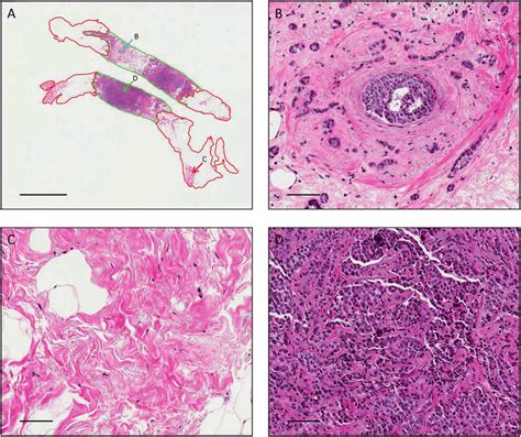 Representative Images Of H E Stained Idca With Dcis Breast Cancer