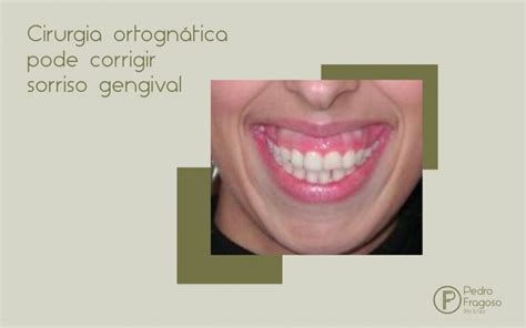 Cirurgia Ortogn Tica Pode Corrigir Sorriso Gengival Dr Pedro Fragoso