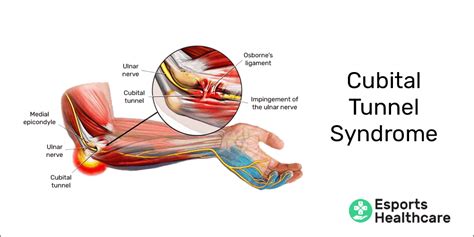 What is Cubital Tunnel Syndrome, tunnel syndrome - plantecuador.com