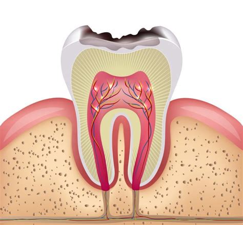 Todo Lo Que Debes Saber Sobre Los Empastes Clínica Dental En Ciudad