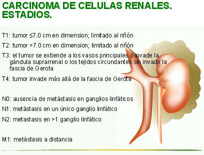 Cáncer renal SEOM Sociedad Española de Oncología Médica 2019