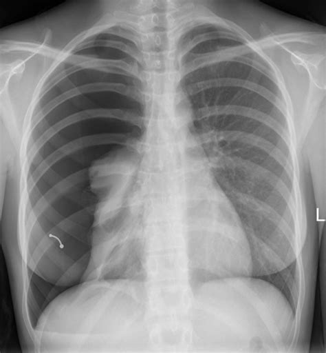 Hydropneumothorax Litfl Lung Ultrasound Library