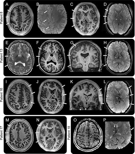 pediatric neurology: Polymicrogyria, thalamic hypoplasia and epilepsy