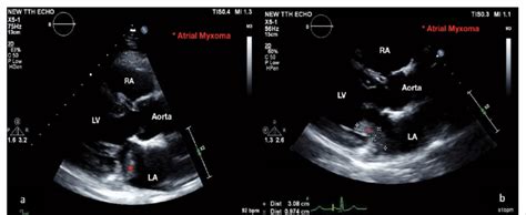 A Transthoracic Echocardiography Demonstrating An Atrial Myxoma In