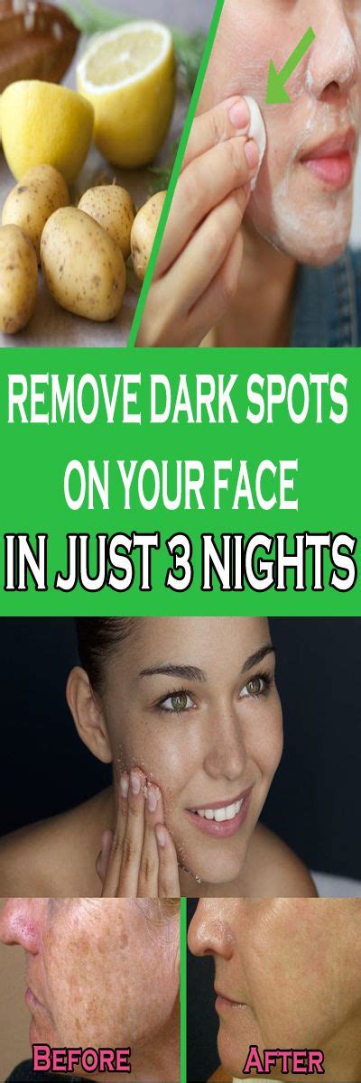 Remove Dark Spots On Your Face In Just 3 Nights Dark Spots On Face Remove Dark Spots Spots