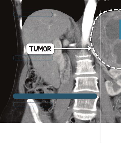 Neuroendocrine Tumors Notes Diagrams And Illustrations Osmosis