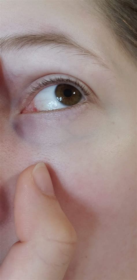 Red Bump In Caruncula Corner Of Eye Rdiagnoseme