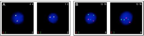 Examples of the fusion gene-specific FISH analysis of case 6. (A ...