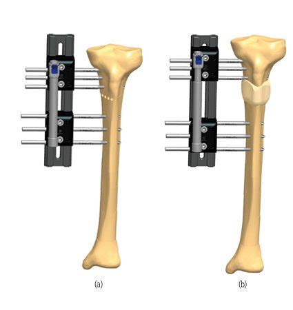 Tibia Lengthening Treatment Orthofix ABS