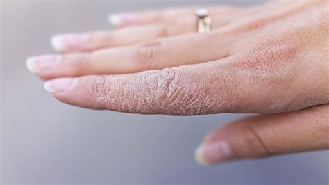 natural home remedies  dry  chapped hands kimdeyir