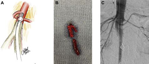 Hybrid Repair For Acute Aortic Occlusion Using Aortobifemoral Bypass And Angiovac Thrombectomy